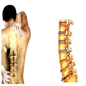 Osteochondrose -Phase