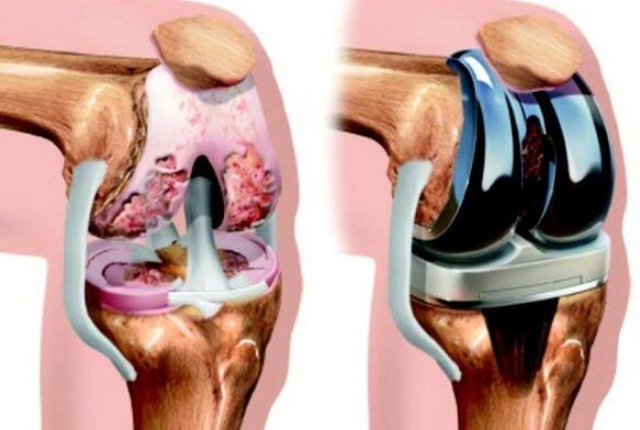 Vor und nach der endoprothetisch des Kniegelenks mit Arthrose