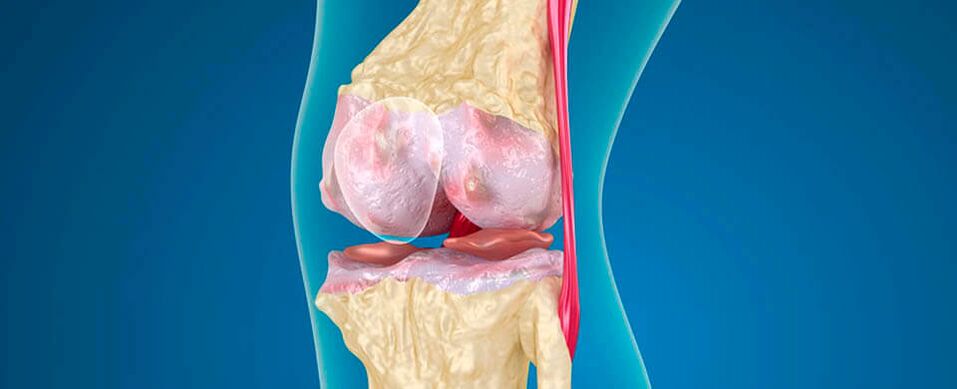 Arthrose des Kniegelenks